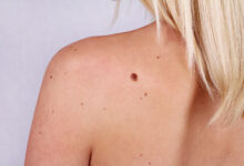 skin tag removal