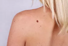 skin tag removal