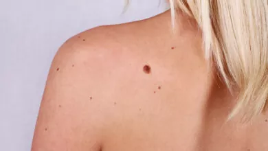 skin tag removal