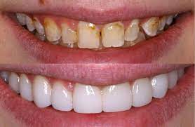 Photo of Everything You Need to Know About Veneers