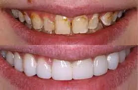 Veneers