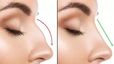 Rhinoplasty