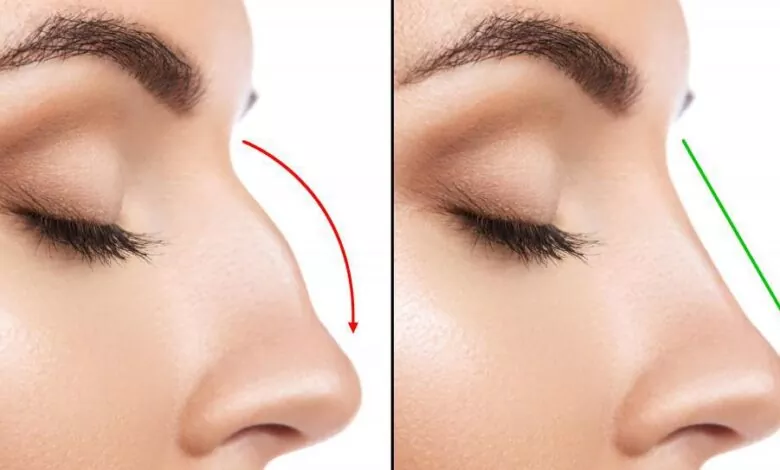 Rhinoplasty